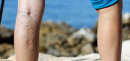 leg with varicose veins